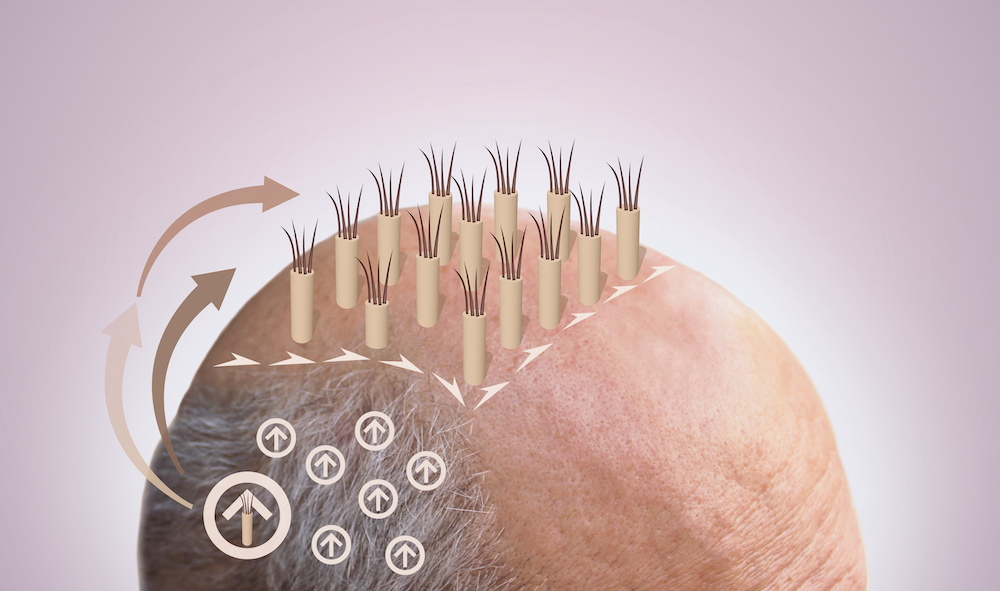 Methods of hair transplantation fut vs fue with infographic elements of illustration.